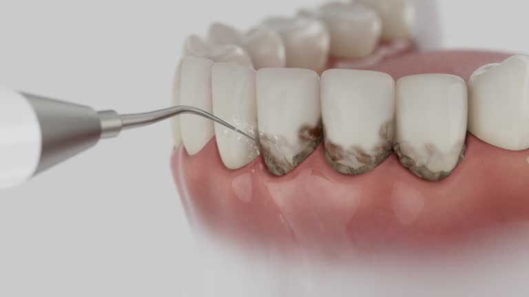 Trusted Wisdom Tooth Removal service in Clewiston, FL - Dentist Open Now